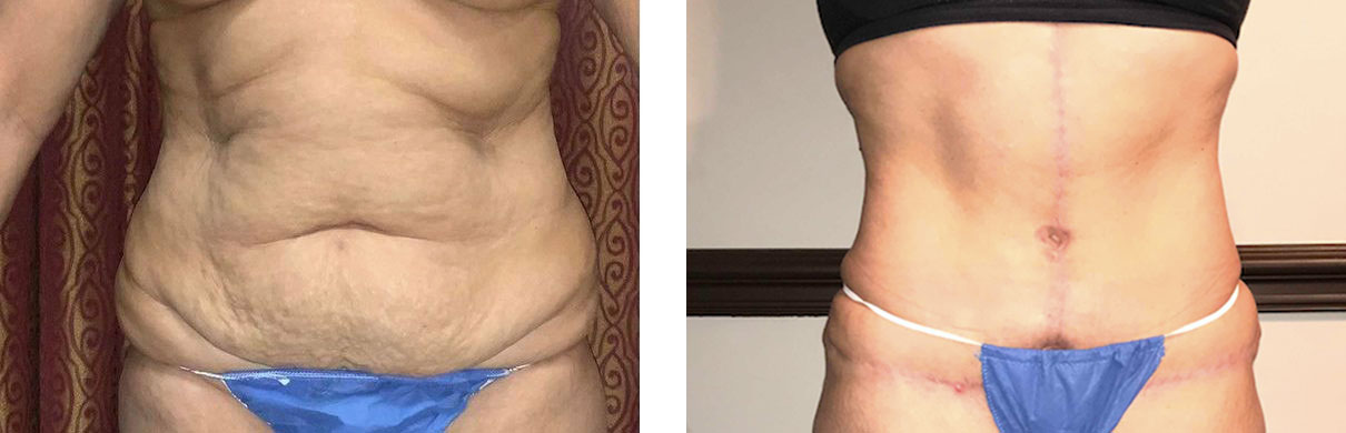Cosmetic Surgery Tulsa | Tummy Tuck - Patient 1 - Front