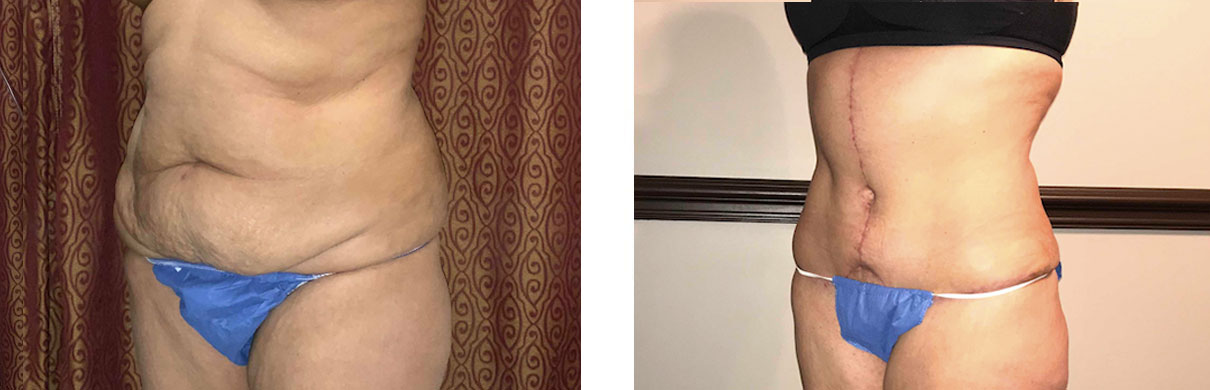 Cosmetic Surgery Tulsa | Tummy Tuck - Patient 1 - Oblique 2