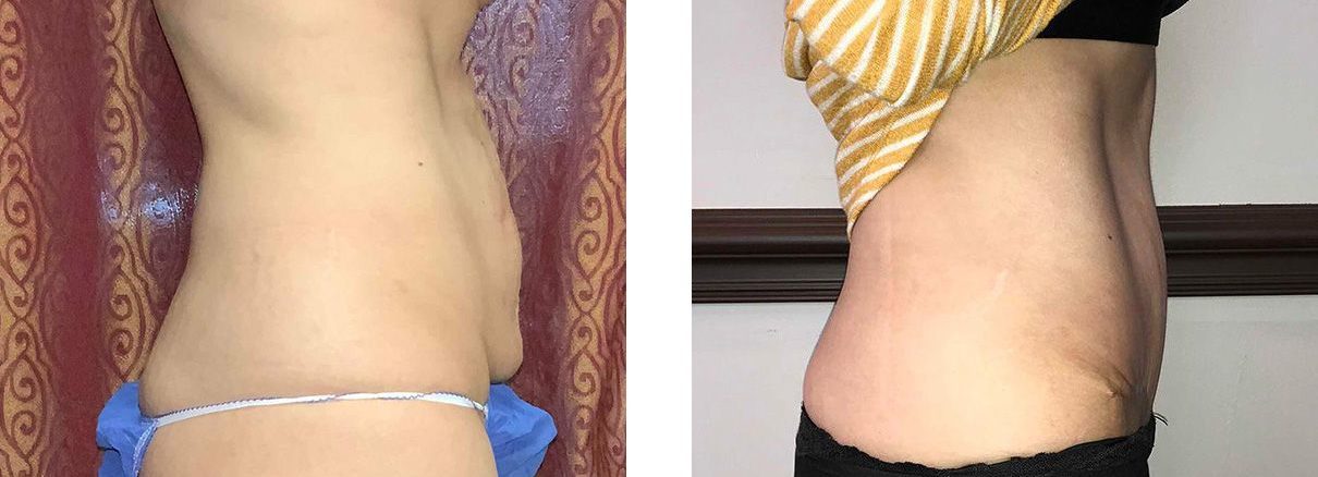 Cosmetic Surgery Tulsa | Tummy Tuck - Patient 1 - Side 1
