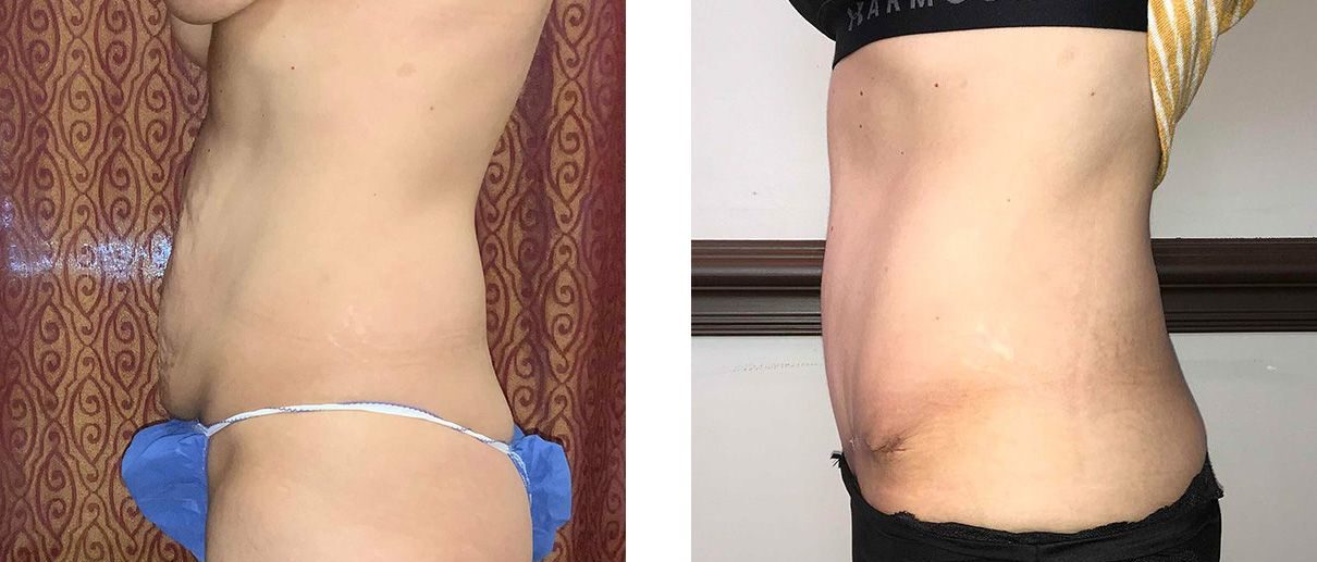 Cosmetic Surgery Tulsa | Tummy Tuck - Patient 1 - Side 2
