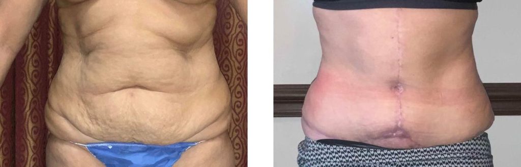 Cosmetic Surgery Tulsa | Tummy Tuck - Patient 2 - Front