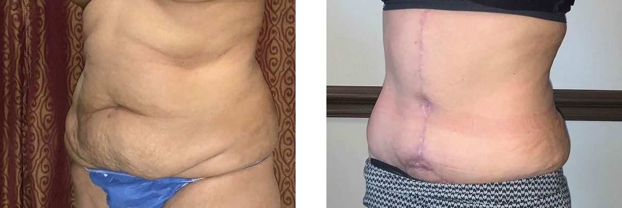 Cosmetic Surgery Tulsa | Tummy Tuck - Patient 2 - Oblique 2