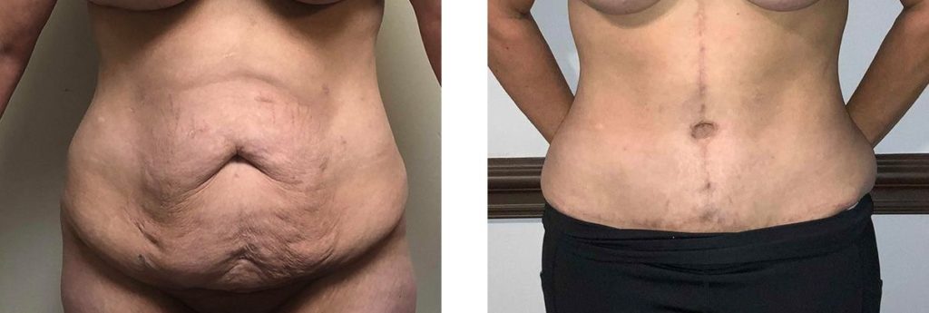 Cosmetic Surgery Tulsa | Tummy Tuck - Patient 4 - Front