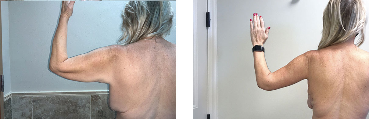 Cosmetic Surgery Tulsa | Brachioplasty - Patient 2 - Left Back