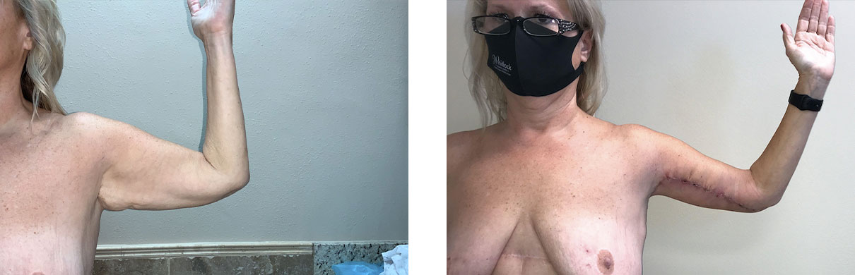 Cosmetic Surgery Tulsa | Brachioplasty - Patient 2 - Left Front
