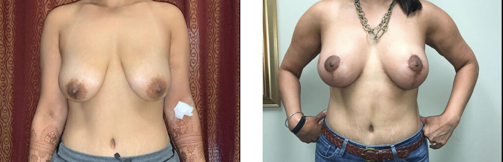 Breast Augmentation Patient 11 Front