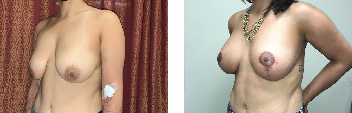 Cosmetic Surgery Tulsa | Breast Augmentation - Patient 4 - Oblique 2