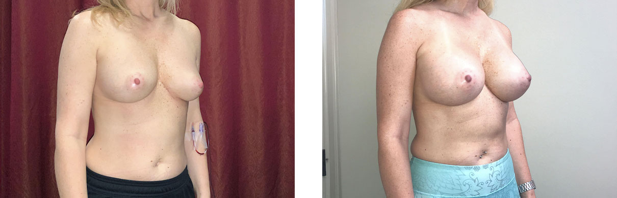Cosmetic Surgery Tulsa | Breast Augmentation - Patient 4 - Oblique 1