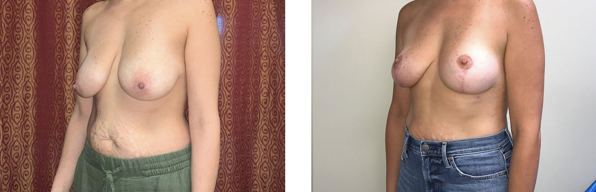 Cosmetic Surgery Tulsa | Breast Lift - Patient 11 - Oblique 2