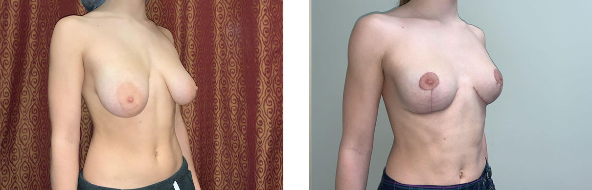 Cosmetic Surgery Tulsa | Breast Augmentation - Patient 1 - Oblique 1