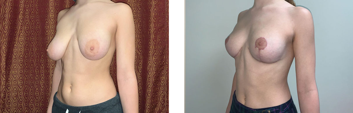 Cosmetic Surgery Tulsa | Breast Augmentation - Patient 1 - Oblique 2
