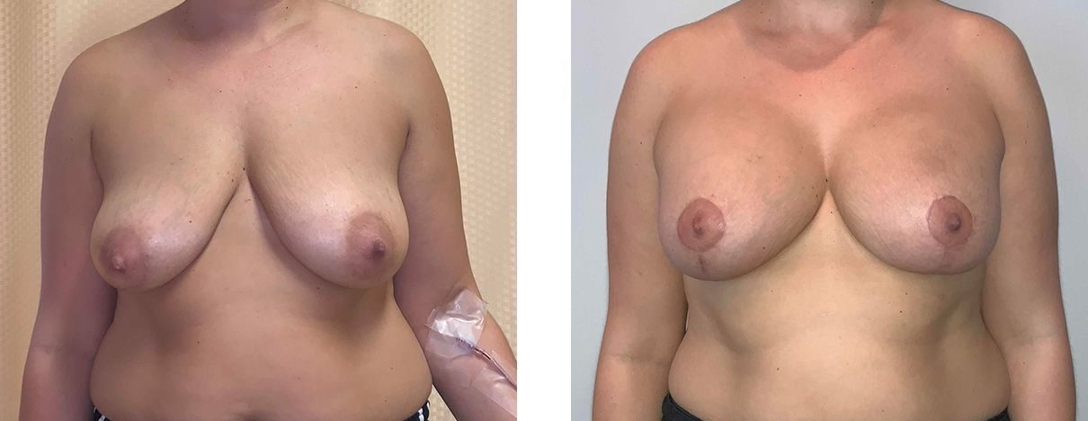 Cosmetic Surgery Tulsa | Breast Lift - Patient 1 - Front