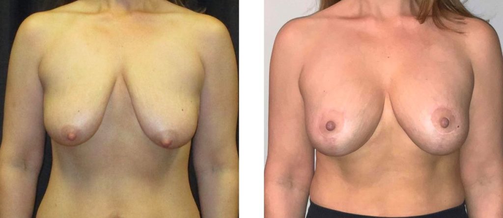Cosmetic Surgery Tulsa | Breast Lift - Patient 2 - Front