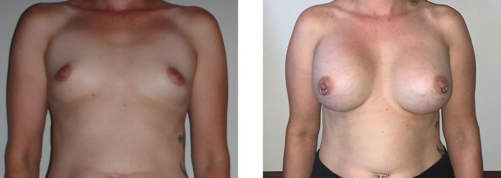 Cosmetic Surgery Tulsa | Breast Augmentation - Patient 1 - Front