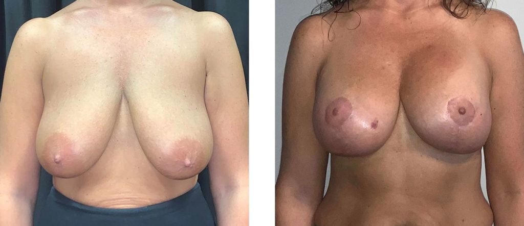 Cosmetic Surgery Tulsa | Breast Lift - Patient 4 - Front