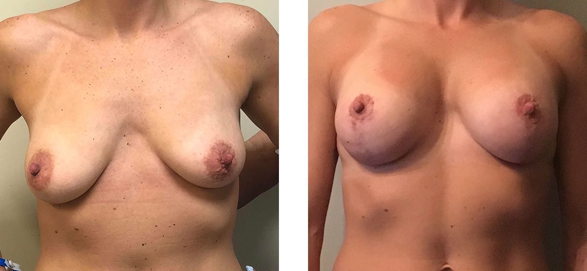 Cosmetic Surgery Tulsa | Breast Lift - Patient 5 - Front