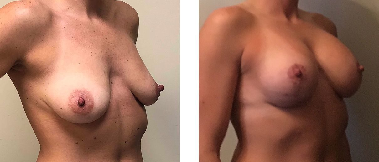 Cosmetic Surgery Tulsa | Breast Lift - Patient 5 - Oblique 1