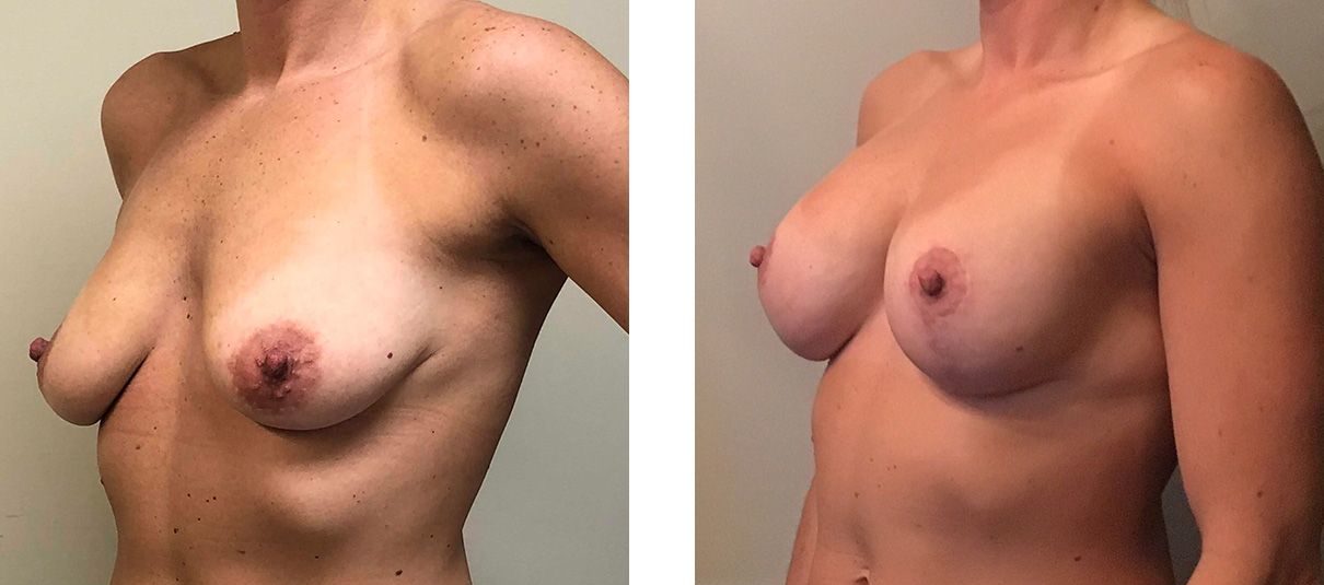 Cosmetic Surgery Tulsa | Breast Lift - Patient 5 - Oblique 2