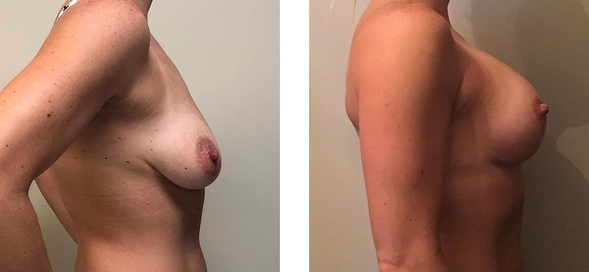 Cosmetic Surgery Tulsa | Breast Lift - Patient 5 - Side 1