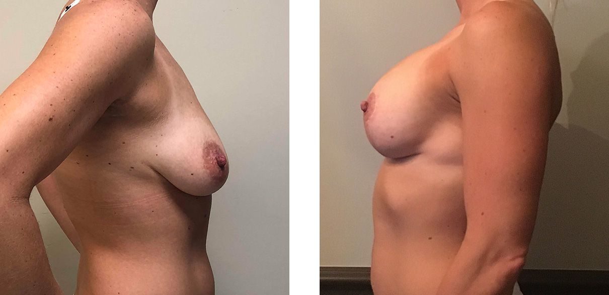 Cosmetic Surgery Tulsa | Breast Lift - Patient 5 - Side 2