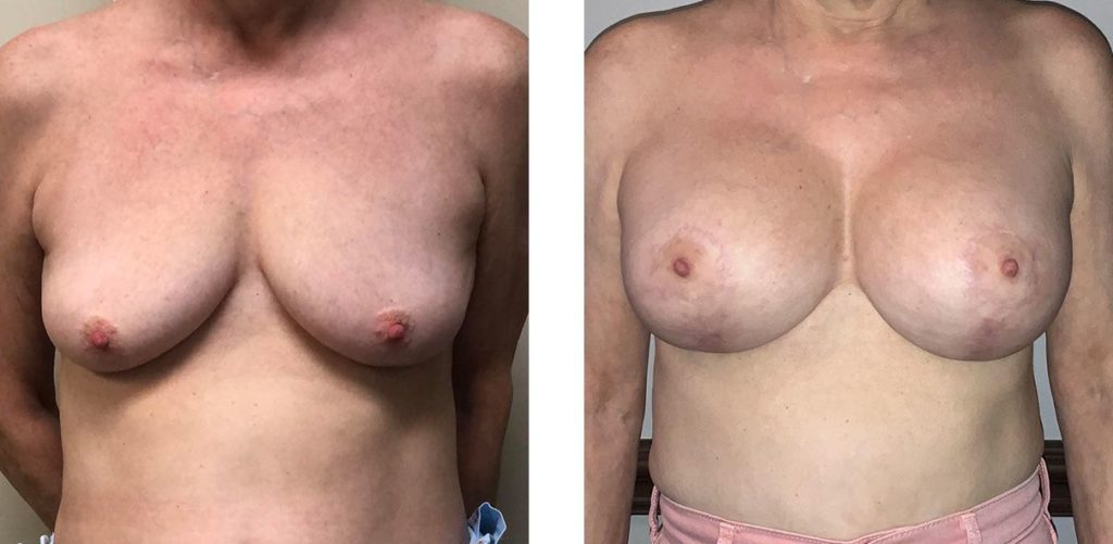 Cosmetic Surgery Tulsa | Breast Lift - Patient 6 - Front