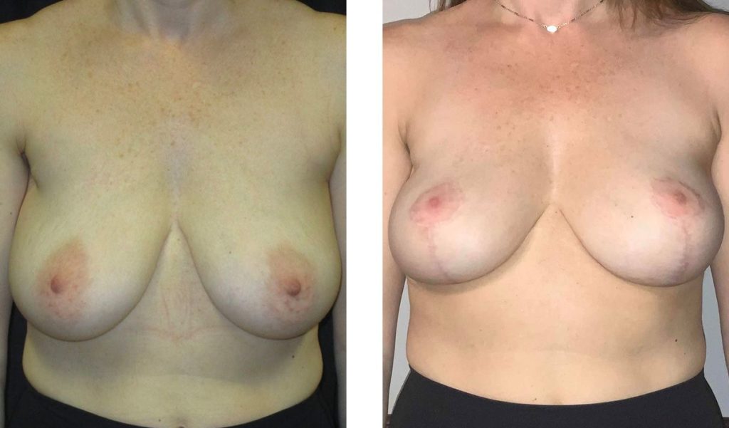 Cosmetic Surgery Tulsa | Breast Lift - Patient 7 - Front