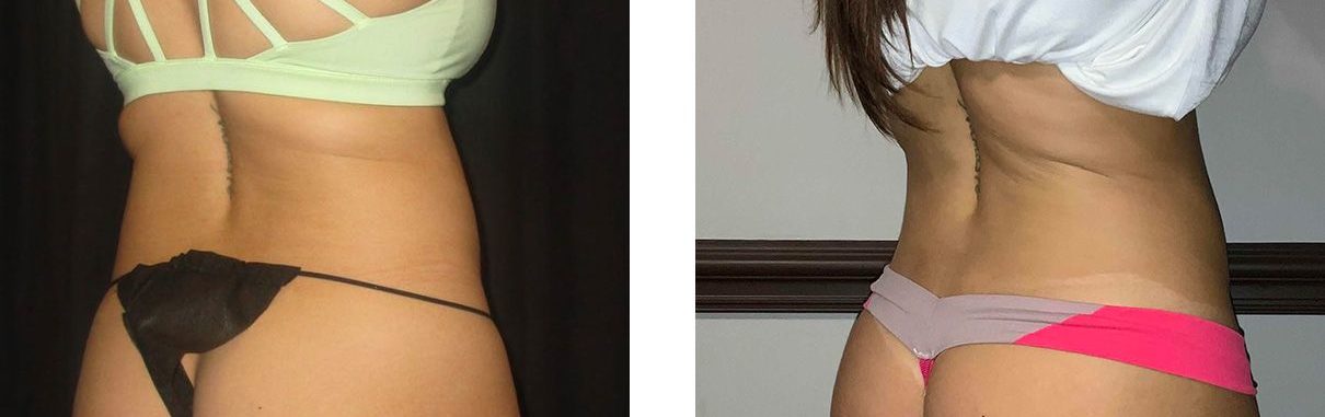 Cosmetic Surgery Tulsa | Liposuction - Patient 1 - Back Oblique 1