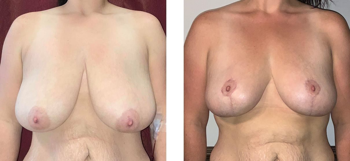 Cosmetic Surgery Tulsa | Breast Lift - Patient 9 - Front