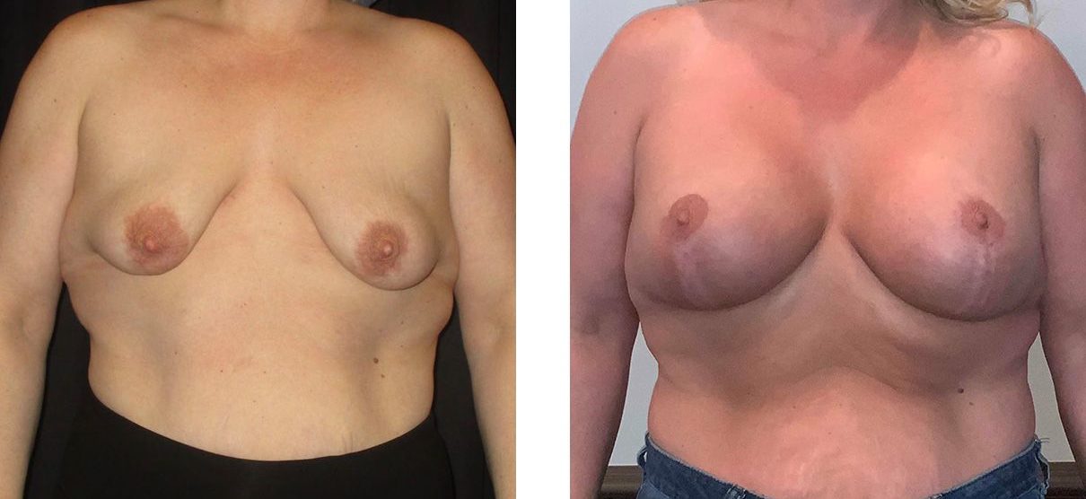 Cosmetic Surgery Tulsa | Breast Lift - Patient 10 - Front