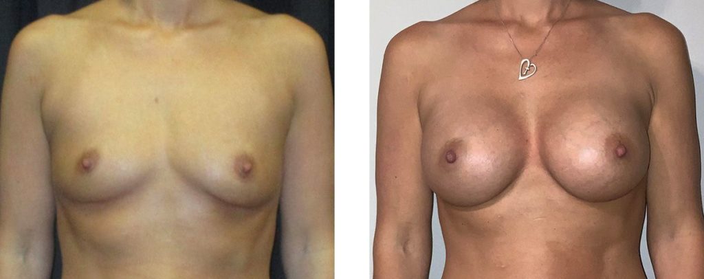 Cosmetic Surgery Tulsa | Breast Augmentation - Patient 3 - Front