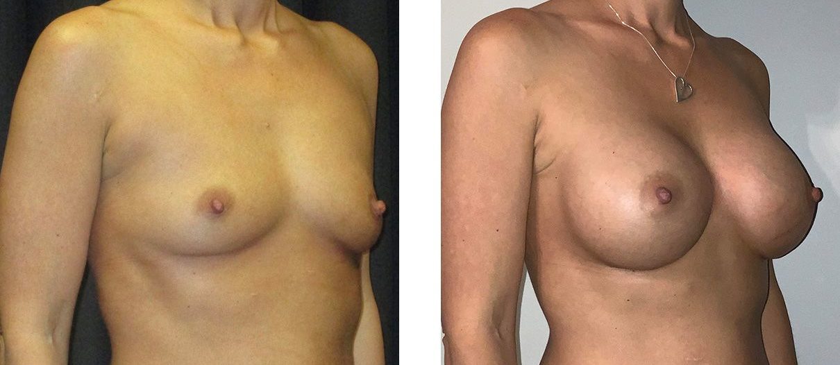 Cosmetic Surgery Tulsa | Breast Augmentation - Patient 3 - Oblique 1