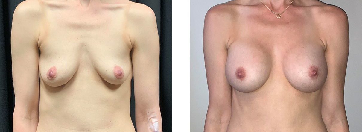 Cosmetic Surgery Tulsa | Breast Augmentation - Patient 4 - Front