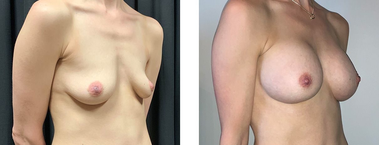Cosmetic Surgery Tulsa | Breast Augmentation - Patient 4 - Oblique 1