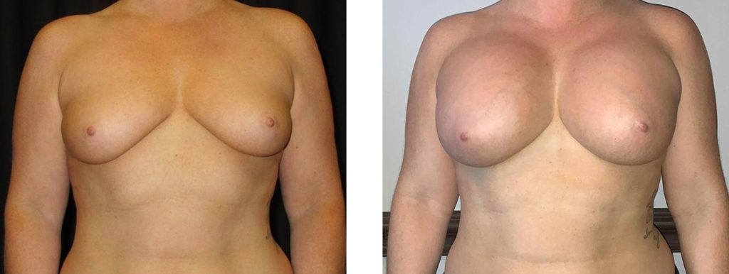 Cosmetic Surgery Tulsa | Breast Augmentation - Patient 5 - Front