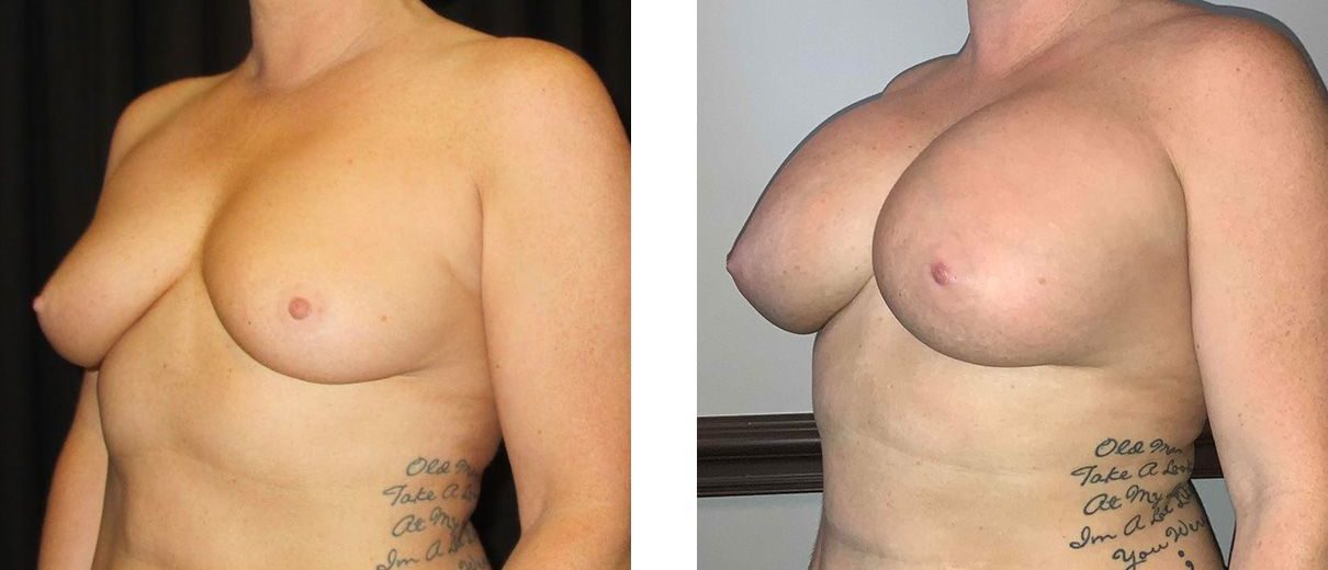 Cosmetic Surgery Tulsa | Breast Augmentation - Patient 5 - Oblique 2