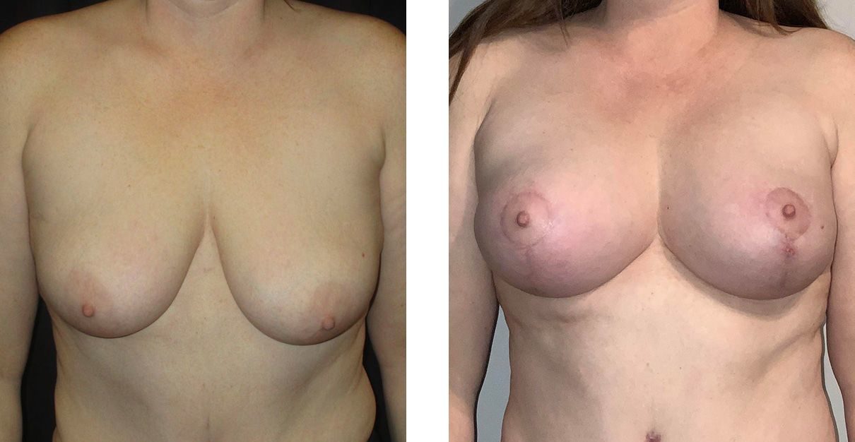 Cosmetic Surgery Tulsa | Breast Lift - Patient 11 - Front