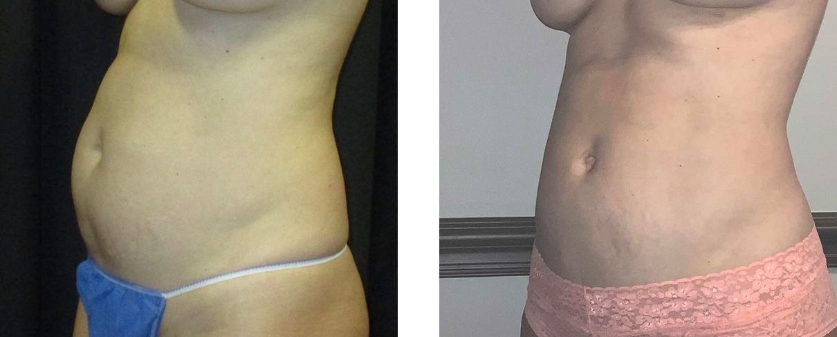 Cosmetic Surgery Tulsa | Liposuction - Patient 2 - Oblique 2