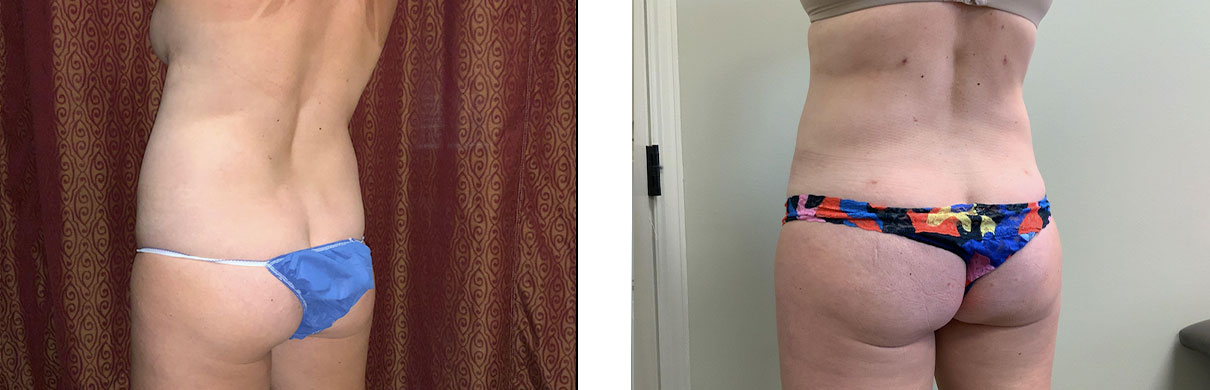 Cosmetic Surgery Tulsa | Liposuction - Patient 1 - Back Oblique 2