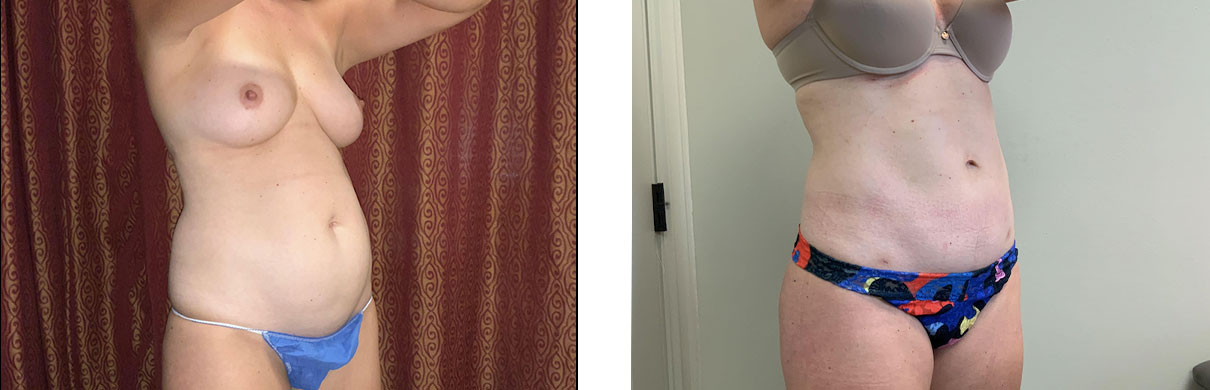 Cosmetic Surgery Tulsa | Liposuction - Patient 1 - Oblique 1