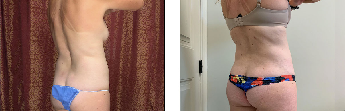 Cosmetic Surgery Tulsa | Liposuction - Patient 1 - Back Oblique 1
