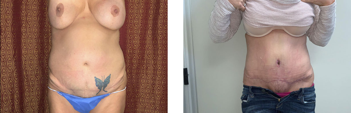 Cosmetic Surgery Tulsa | Liposuction - Patient 1 - Front
