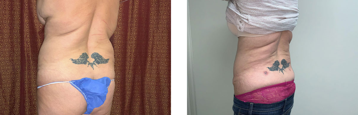 Cosmetic Surgery Tulsa | Liposuction - Patient 1 - Back Oblique 2