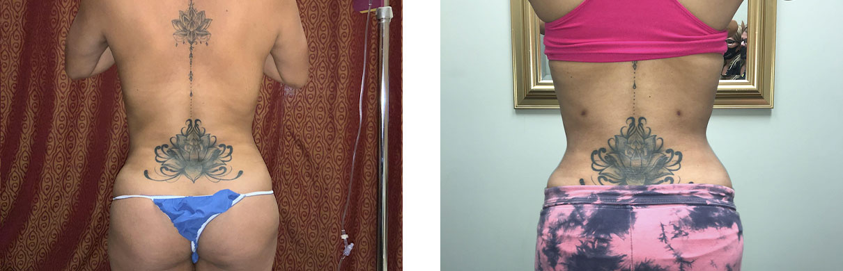 Cosmetic Surgery Tulsa | Liposuction - Patient 1 - Back