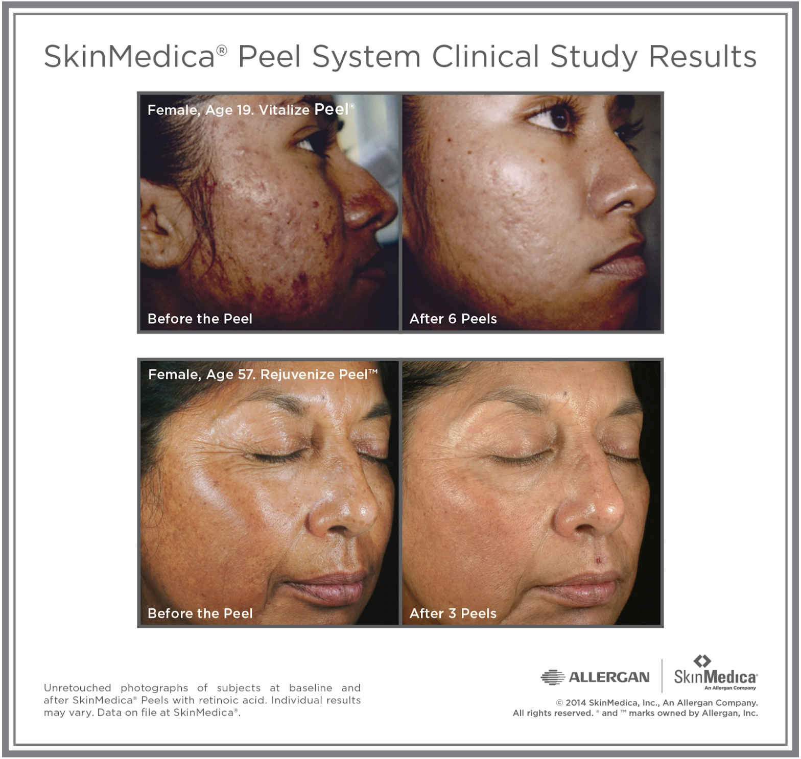 Tulsa Cosmetic Surgery Chemical Peels 1