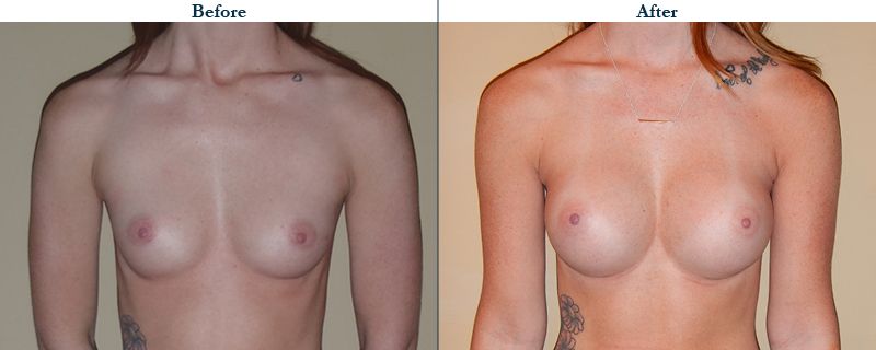 Tulsa Cosmetic Surgery Whitlock Breast Augmentation Before After Web16