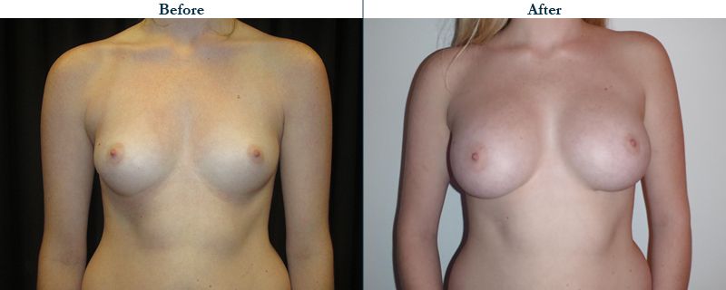 Tulsa Cosmetic Surgery Whitlock Breast Augmentation Before After Web18