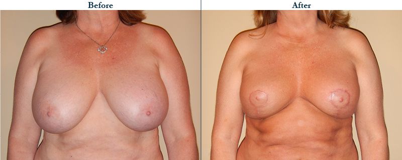 Tulsa Cosmetic Surgery Whitlock Breast Lift Before After Web27