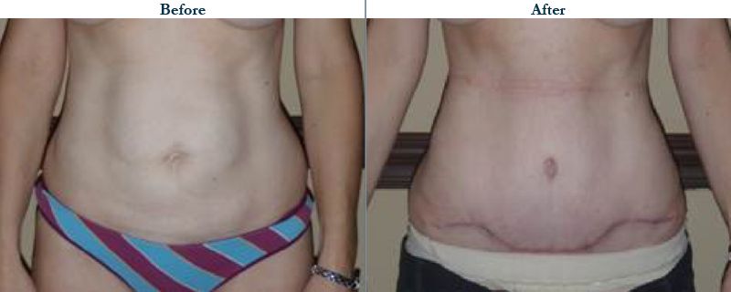 Tulsa Cosmetic Surgery Whitlock Tummy Tuck Before After Web39